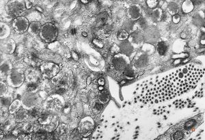 M,40y. | granular cell tumor M,40y. | granular cell tumor